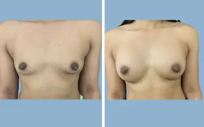 Before and After